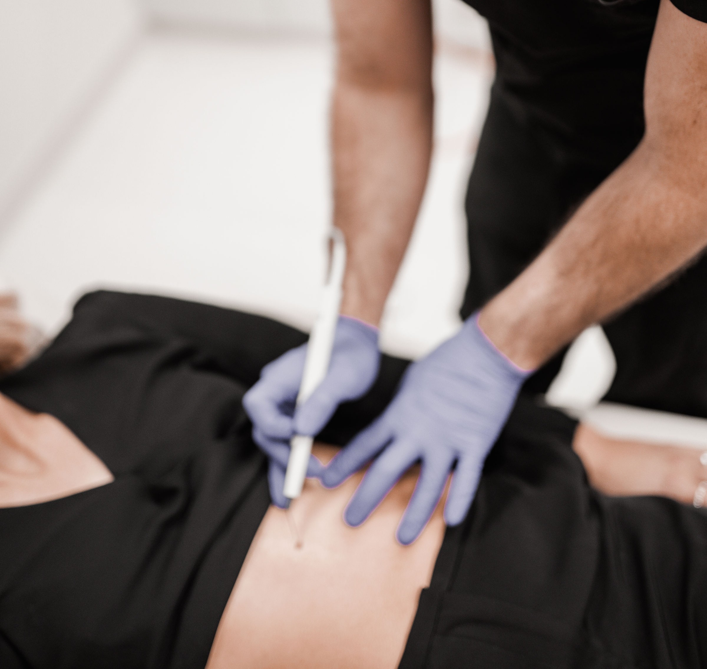 Skin tag removal Shellharbour Skin